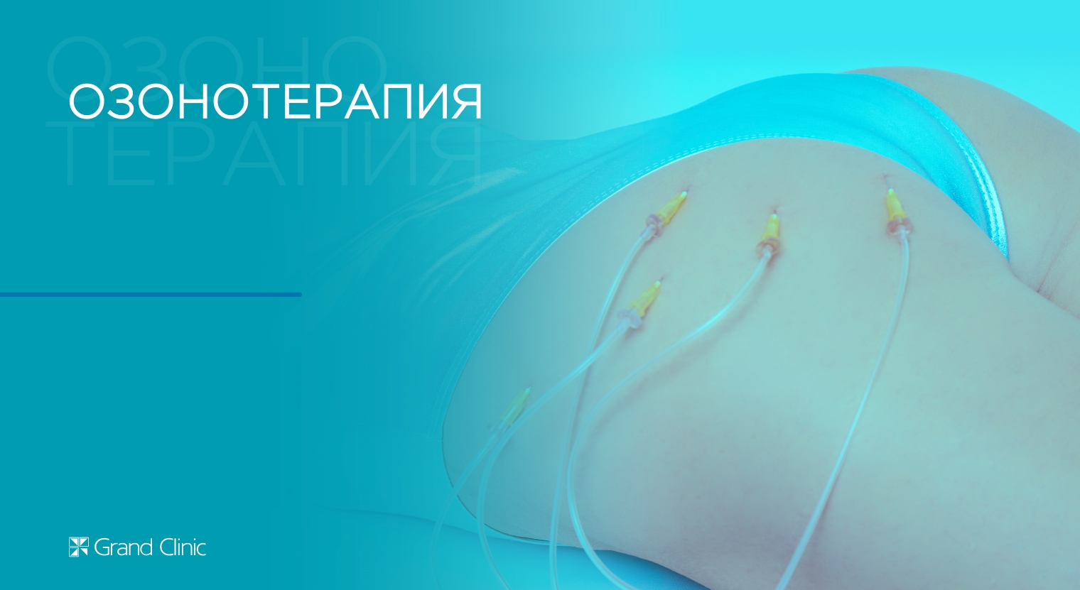 Смотреть видео о процедуре Озонотерапия